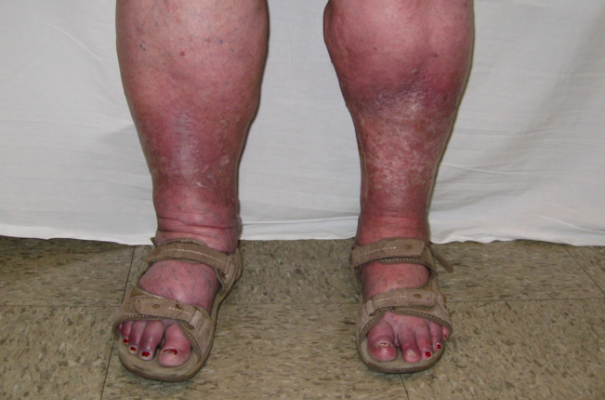 Understanding Lower Extremity Phlebolymphedema Fibrosis