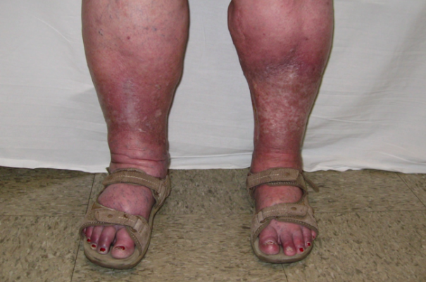 Lower Extremity Lymphedema and Edema