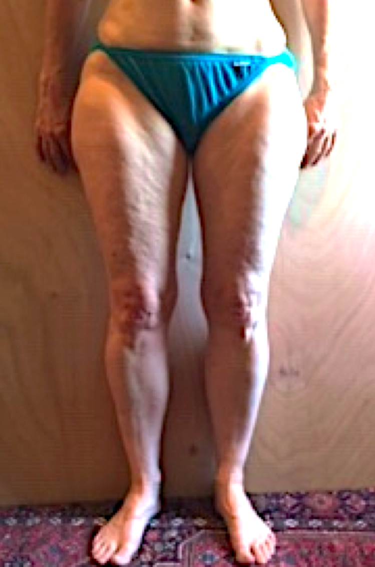 How Can I Slow the Likely Progression of My Lipedema? - Total