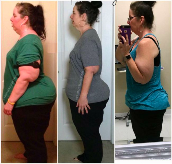 Can you lose weight with Lipedema? - Lipedema and Me