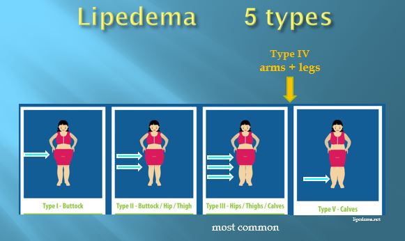 Understanding Lipedema and Empowering Our Patients | Lymphatic ...