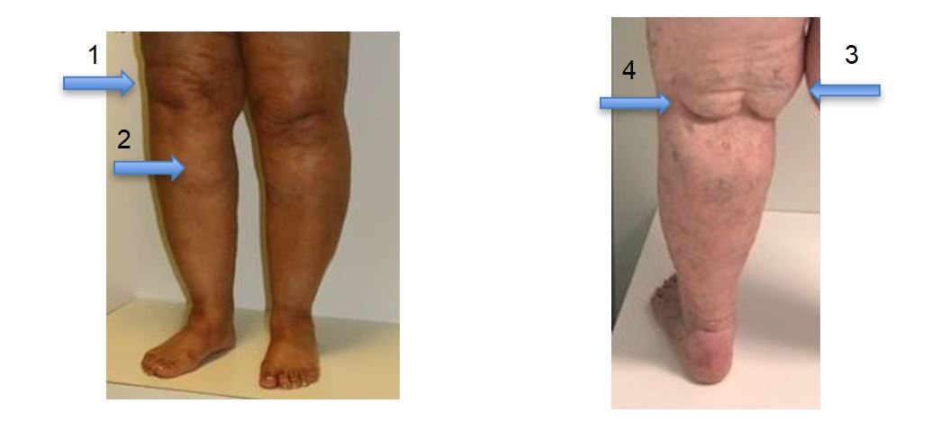 Lipedema About Lipedema And Lymphedema Dercums Disease Swollen Images