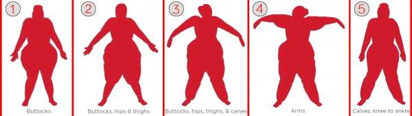 Lipedema: The Disease They Call FAT — WITHINGS BLOG